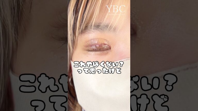 【二重整形】二重切開したら○ヶ月経ったら可愛すぎる二重が爆誕した #shorts