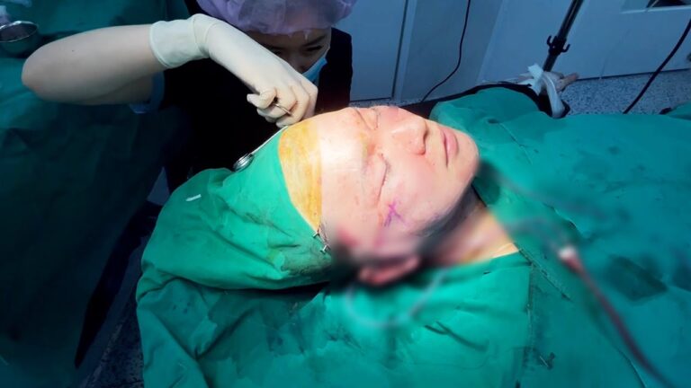 【韓国整形】顔がグチャグチャになりました（切開リフト）