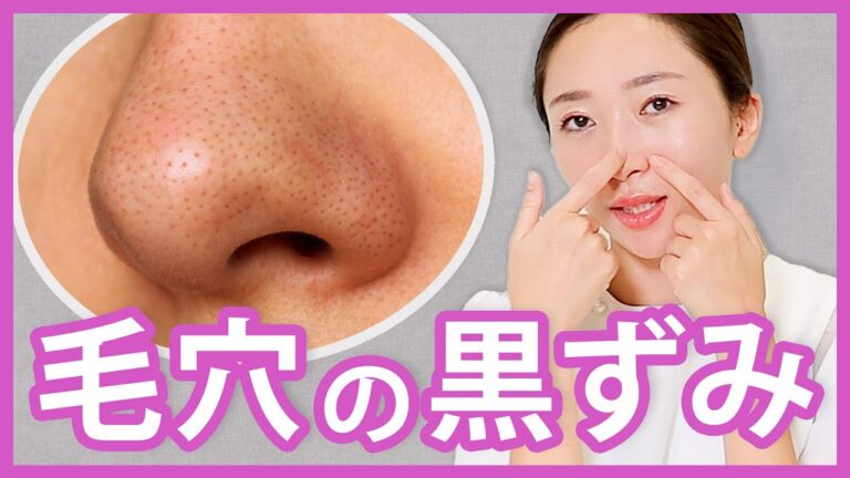 毛穴の黒ずみの原因と、自宅でできるケアについて主婦ドクターが解説します