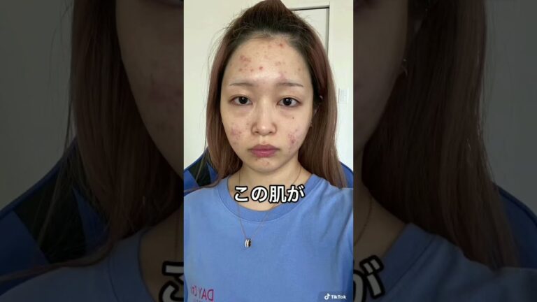 TikTokで240万回再生されたニキビを1日で治す方法が天才的すぎたwww