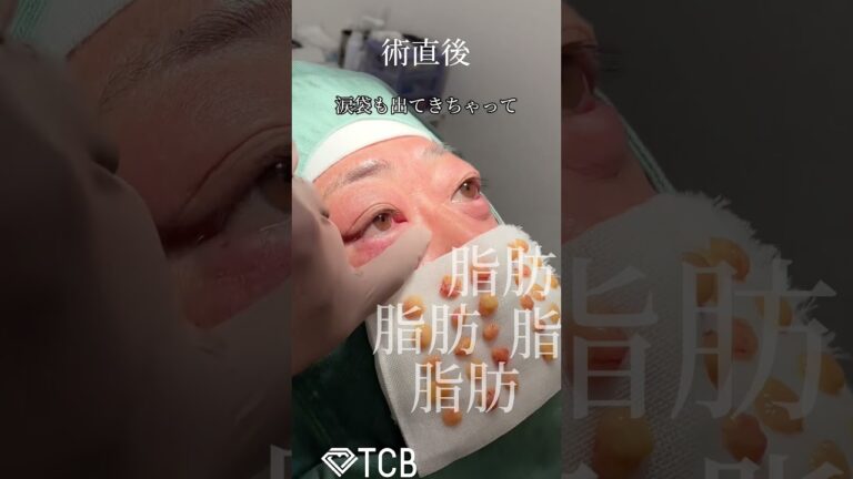 【クマ取り】#shorts