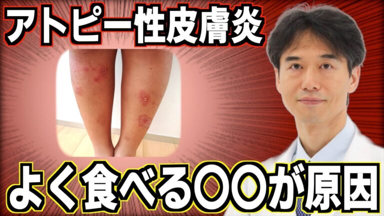 アトピー性皮膚炎が悪化する食べ物とは？肌の湿疹トラブルを改善する食事について解説！