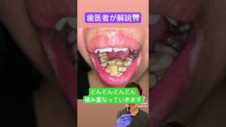 口の中に岩？🦷#shorts #歯石 #歯石除去 #tartar #tartarremoval #プラーク #クリーニング #歯医者  #歯科衛生士 #雑学 #歯医者あるある #スケーリング #歯周病