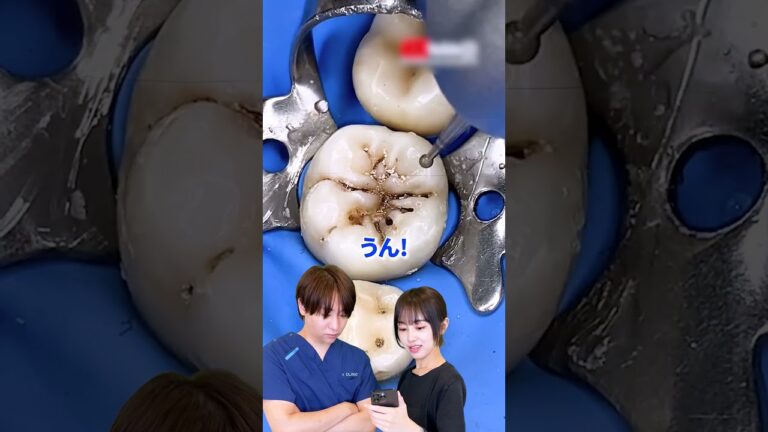 【虫歯治療】手遅れになる前に絶対見て！虫歯を放置した結果が恐ろしい #虫歯 #歯周病 #aclinicデンタル